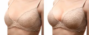 Breast-Augmentation-Before-and-After-Pictures-2