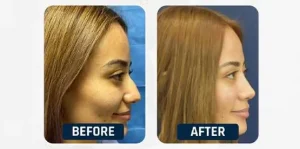 rhinoplasty-in-istanbul-